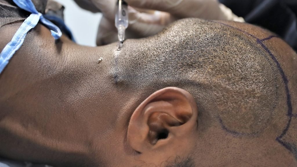 a comprehensive guide to hair transplant prices and costs 2