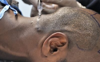 a comprehensive guide to hair transplant prices and costs 2