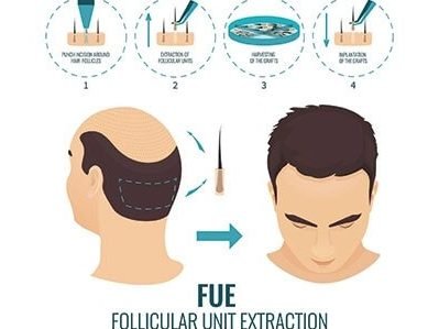 benefits of hair transplantation