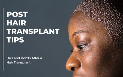 best practices for hair transplant recovery 1