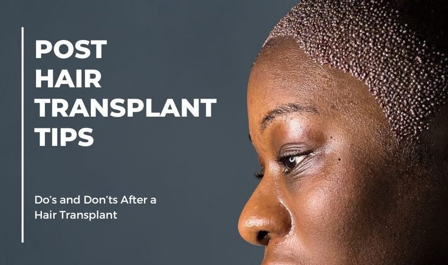 best practices for hair transplant recovery 1