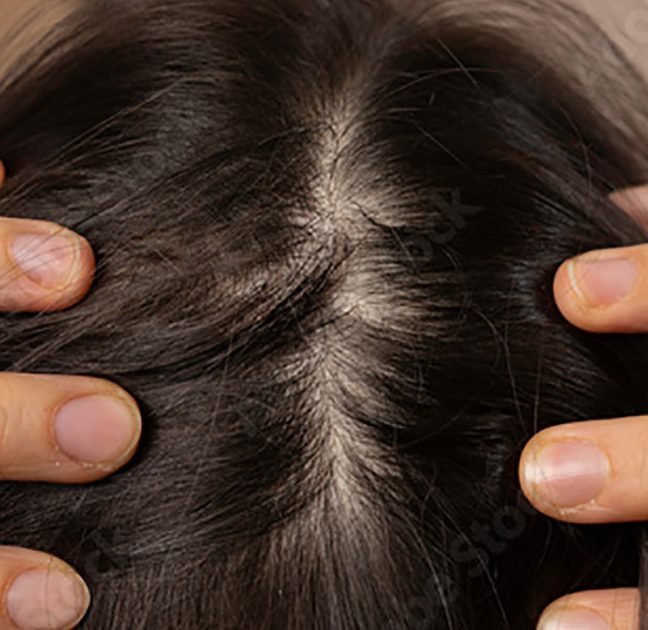 choosing the best hair transplant shampoo for optimal hair growth 3