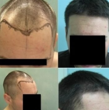 choosing the right hair transplant surgeon