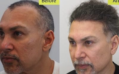 cost of hair transplant procedures