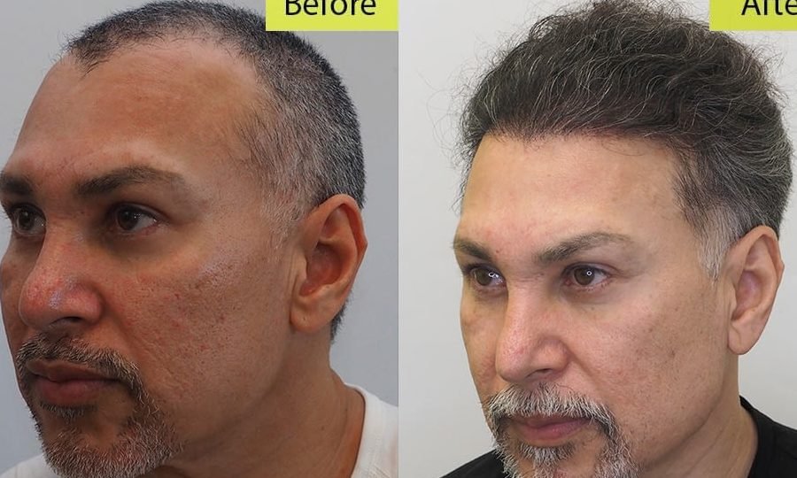 cost of hair transplant procedures