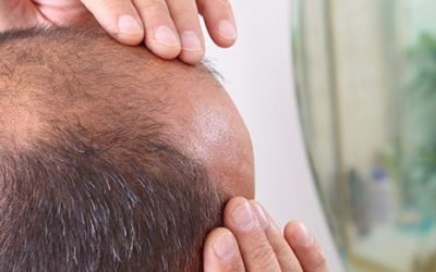 dispelling the myths about hair transplants