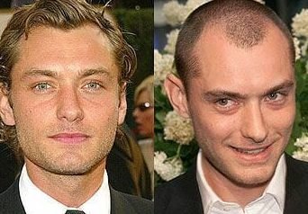 exploring alternative options to hair transplantation 3