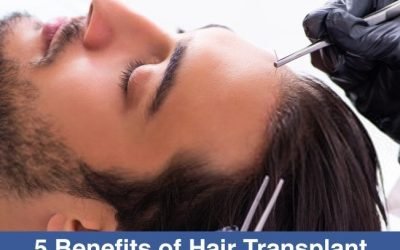 exploring the benefits of hair transplant surgery