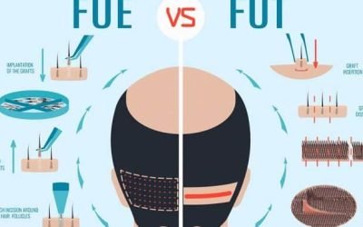 exploring the different types of hair transplantation 1