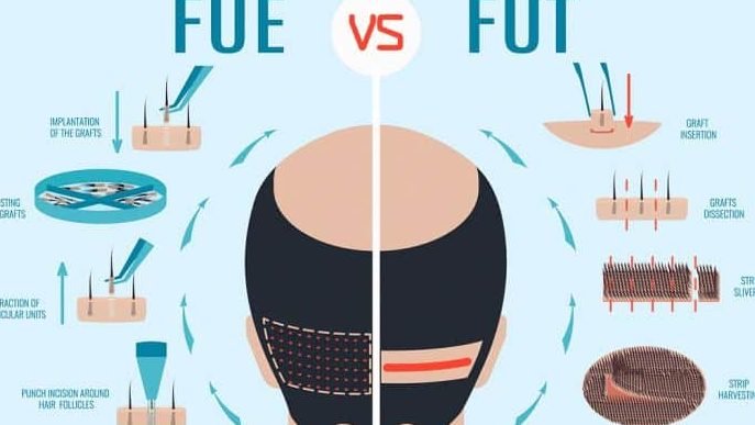 exploring the different types of hair transplantation 1