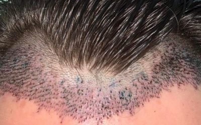 grow your confidence with hair transplantation 1