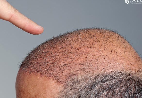 hair loss treatments hair transplant surgery
