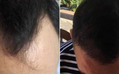 hair transplant exploring the benefits and risks