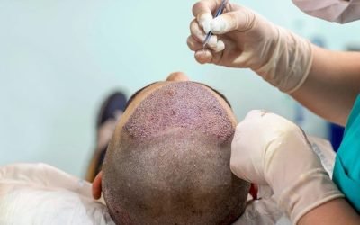 hair transplant recovery what to expect
