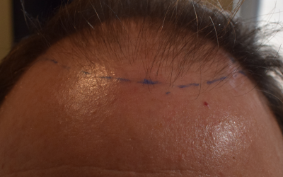 hair transplant surgery how to prepare