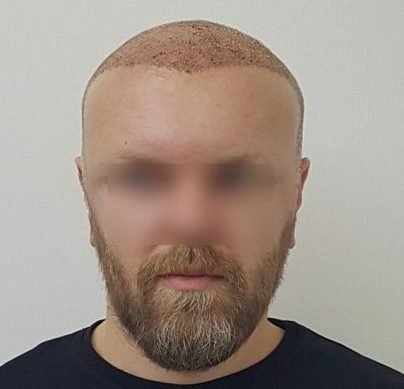 hair transplant surgery risks and side effects