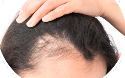 hair transplant techniques for hair restoration