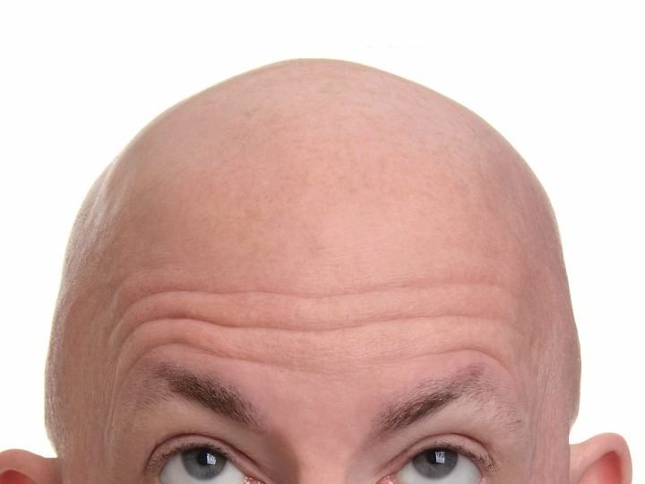 hair transplant the pros and cons 2