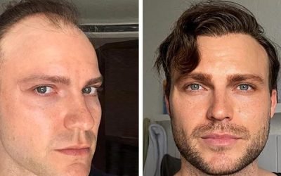 hair transplantation an overview of techniques and results 10