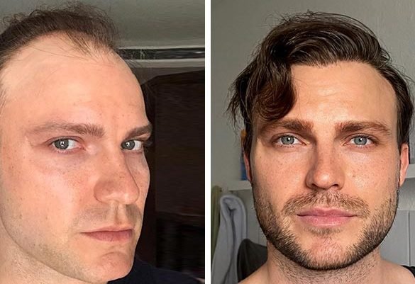 hair transplantation an overview of techniques and results 10