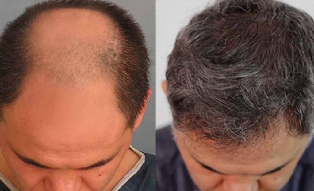 how hair transplant surgery can restore hair