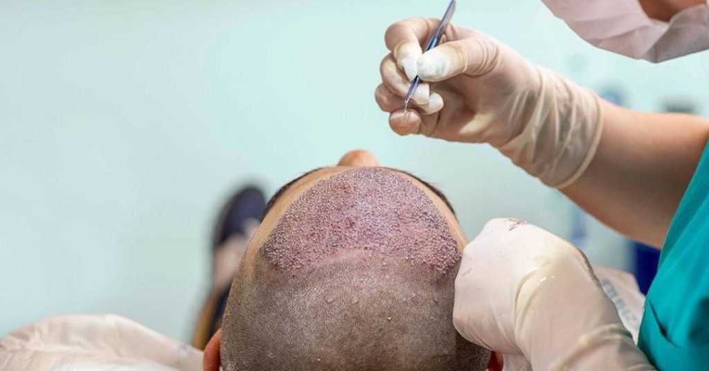 how to select the best hair transplant surgeon for your needs 1