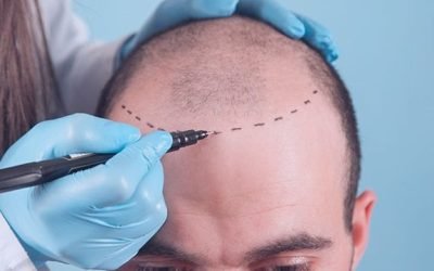 pre and post care for hair transplantation 1