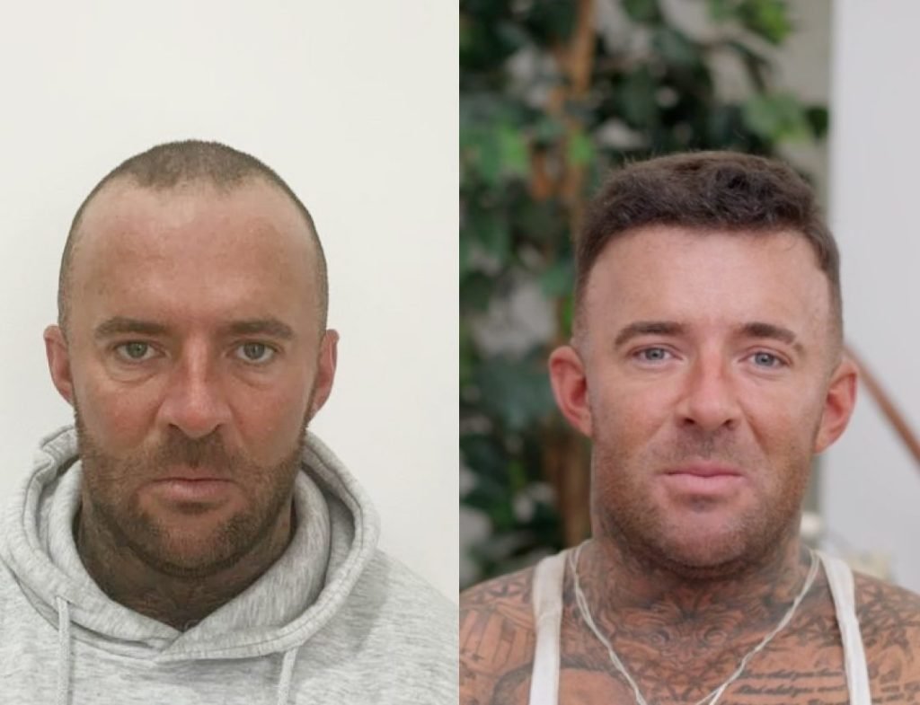 preparing for a hair transplant