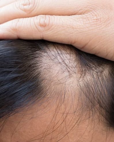 reaping the rewards of hair restoration surgery