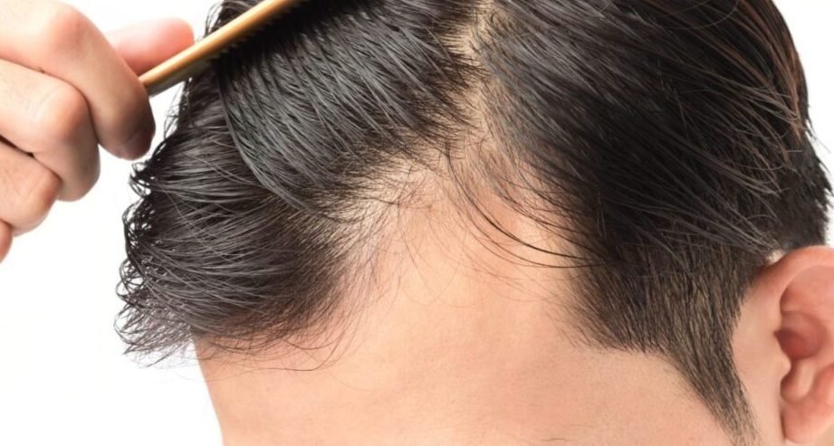 the benefits of hair transplant surgery 1