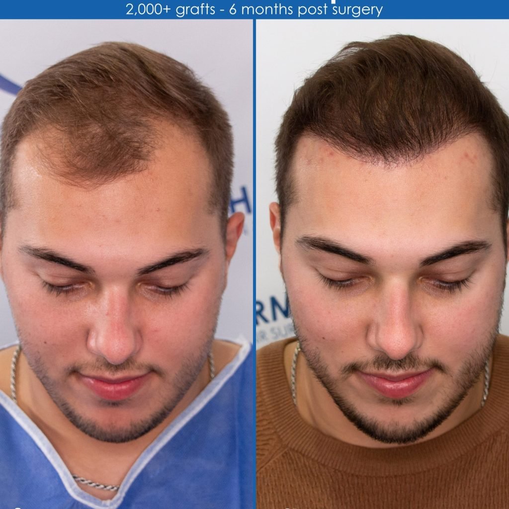 the different types of hair transplant surgery