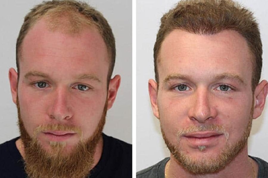 the different types of hair transplant techniquesthe latest trends in hair transplant surgery