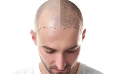 the pros and cons of hair transplantation