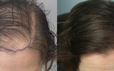 uncovering the basics of hair transplantation 1