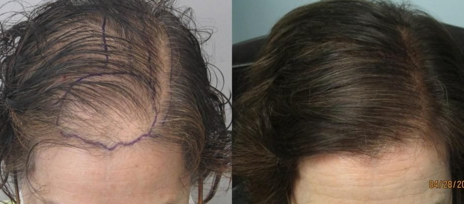 uncovering the basics of hair transplantation 1