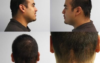 understanding hair transplant surgery