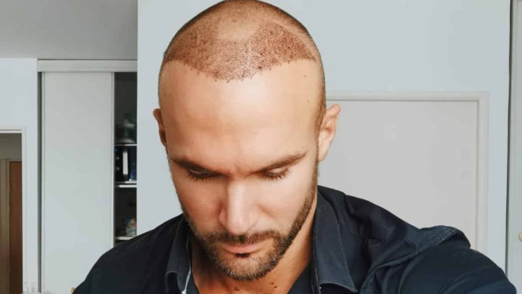 understanding the hair transplant process 1