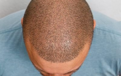 understanding the hair transplant process 2