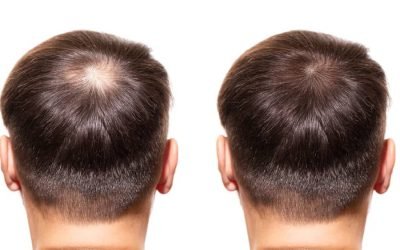 understanding the perks of hair transplant surgery