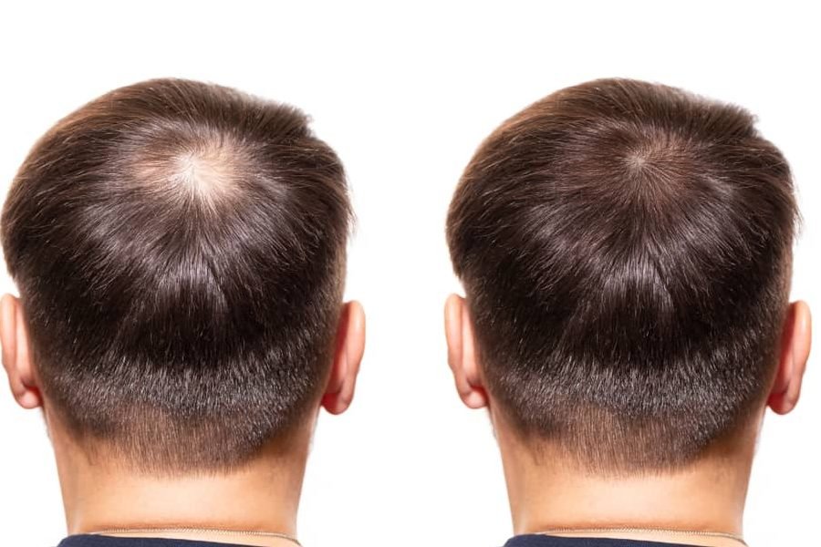 understanding the perks of hair transplant surgery