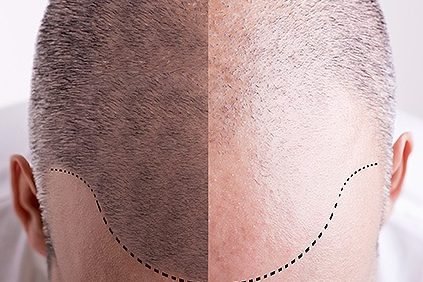 what to consider before getting a hair transplant 2