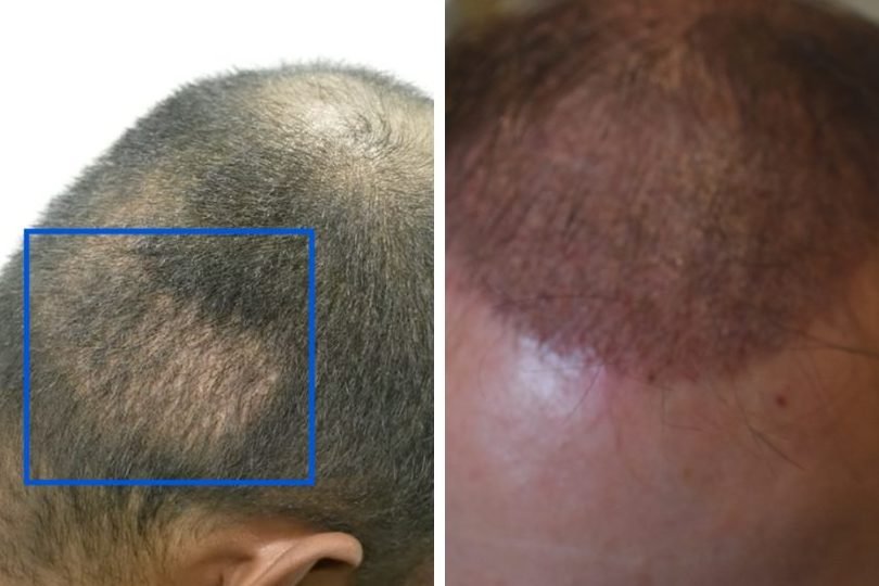 what to expect after a hair transplant surgery 2