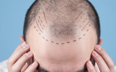 wie haartransplantationen unser aussehen verbessern