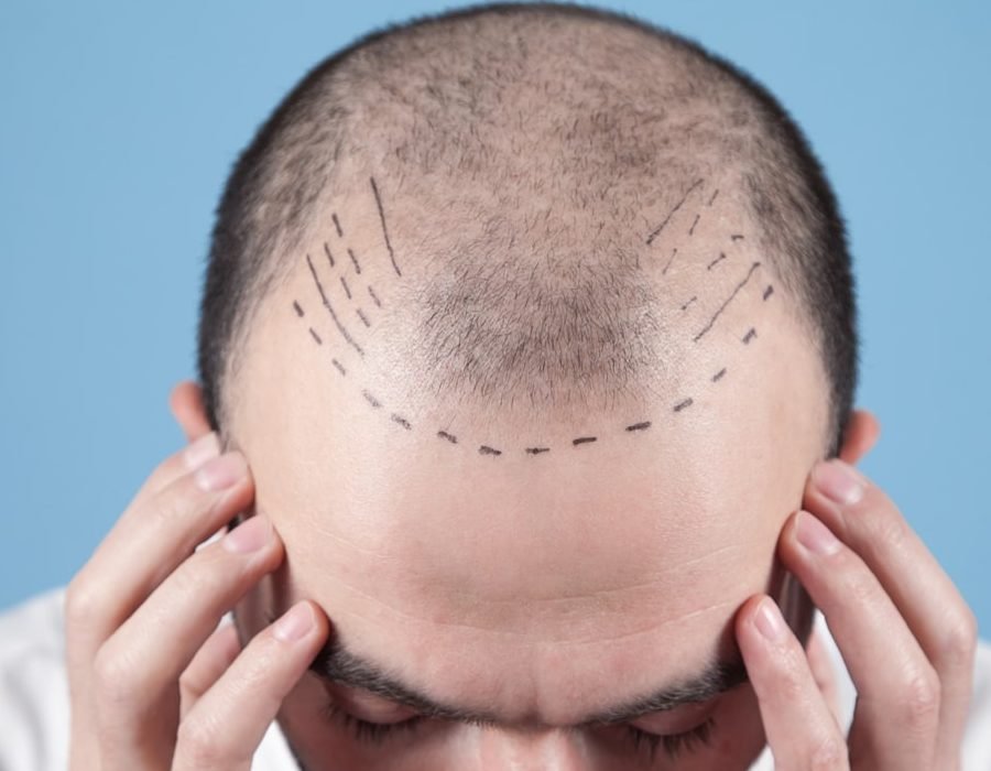 wie haartransplantationen unser aussehen verbessern