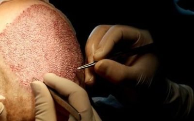 wie haartransplantationen unser wohlbefinden steigern 1