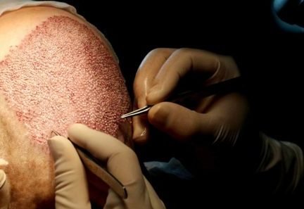 wie haartransplantationen unser wohlbefinden steigern 1