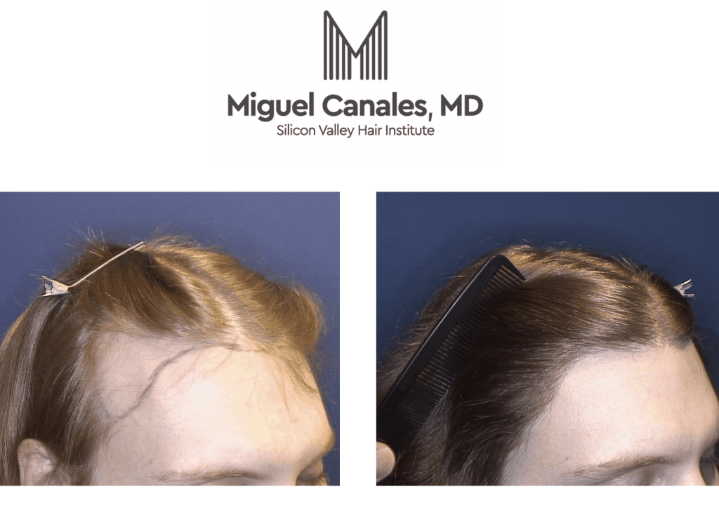 exploring the possibilities of hair transplantation