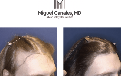 exploring the possibilities of hair transplantation