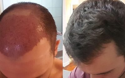 hair transplantation an overview of the pros and cons