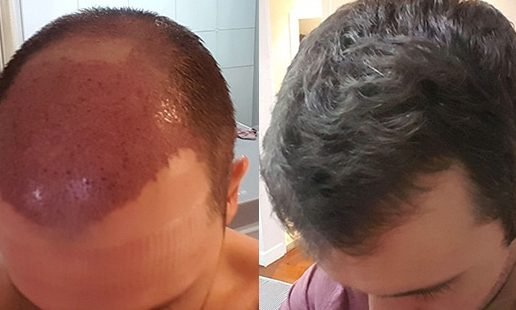 hair transplantation an overview of the pros and cons